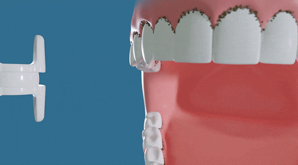 Miracle Smile Magic Flosser directing water around a model tooth